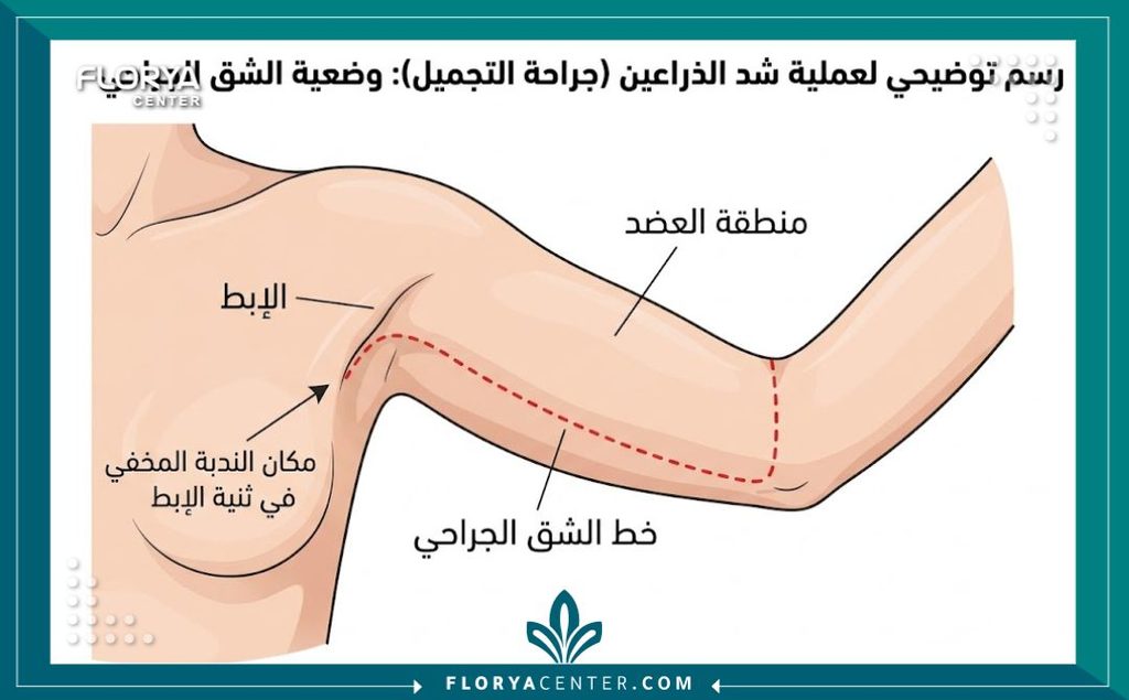 رسم طبي يوضح مكان شق عملية شد الزنود المخفي من الداخل وفي الإبط لتجنب الندبات الواضحة.