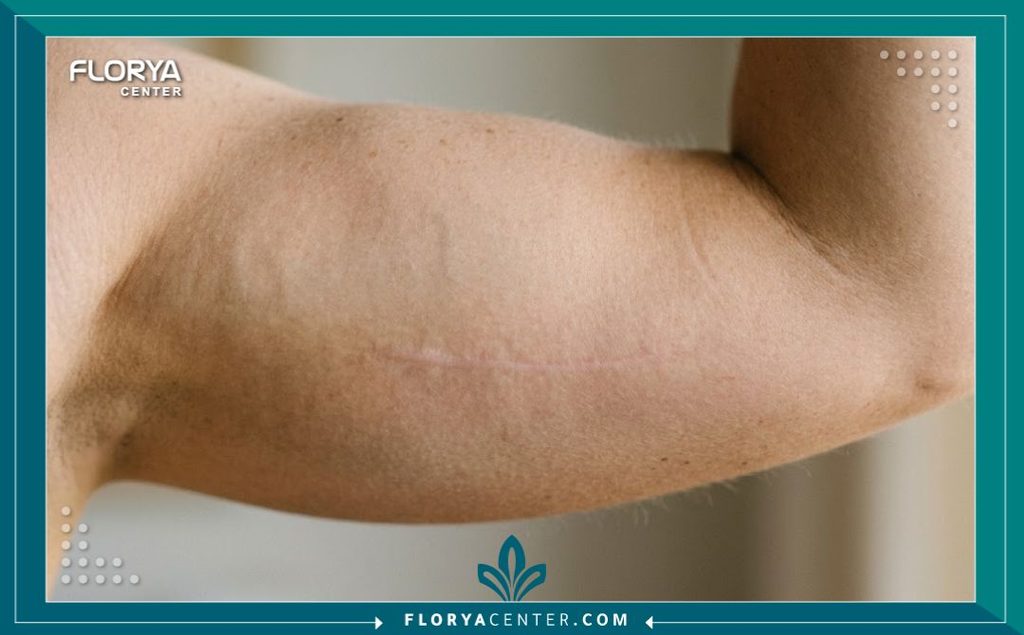 صورة مقربة توضح شكل ندبة شد الذراعين بعد التعافي الكامل وتطبيق كريمات التجميل وكيف تبدو باهتة وغير ملحوظة.