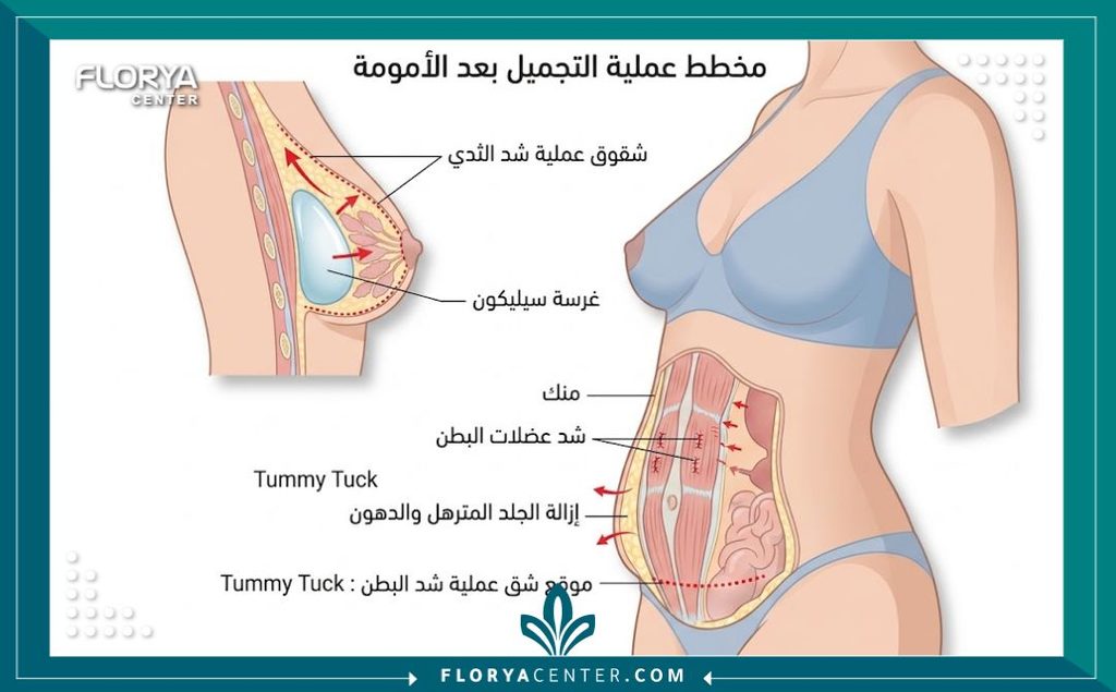 هل عملية المامي ميك أوفر خطيرة؟ 2 رسم توضيحي طبي يوضح مناطق الجراحة الآمنة في عملية المامي ميك أوفر لشد البطن وتجميل الثدي.