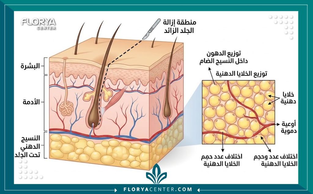 رسم توضيحي طبي لطبقات الجلد وتوزيع الخلايا الدهنية بعد عملية قص الجلد الزائد.