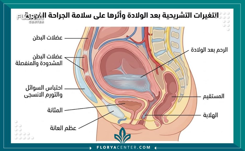 رسم توضيحي طبي يظهر تمدد الرحم وعضلات البطن بعد الولادة القيصرية لتوضيح أسباب رفض عملية الشد الفوري.
