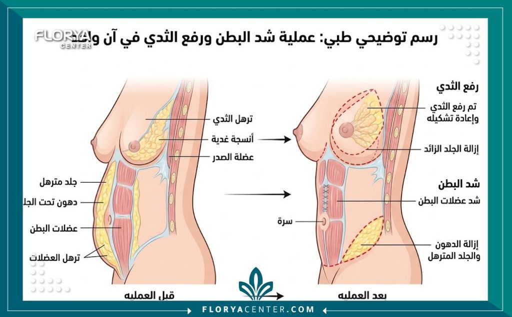 هل يمكن شد البطن والثدي في نفس الوقت؟ 2 رسم توضيحي طبي يوضح تشريحياً كيفية إجراء عملية شد البطن ورفع الثدي في نفس الوقت لشد الترهلات.