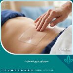 استخدام لصقات سيليكون جروح العمليات لتجميل وتسطيح الندبات بعد الجراحة.