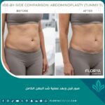 صور قبل وبعد عملية شد البطن الكامل توضح نتائج الجراحة التجميلية المذهلة للتخلص من الترهلات.