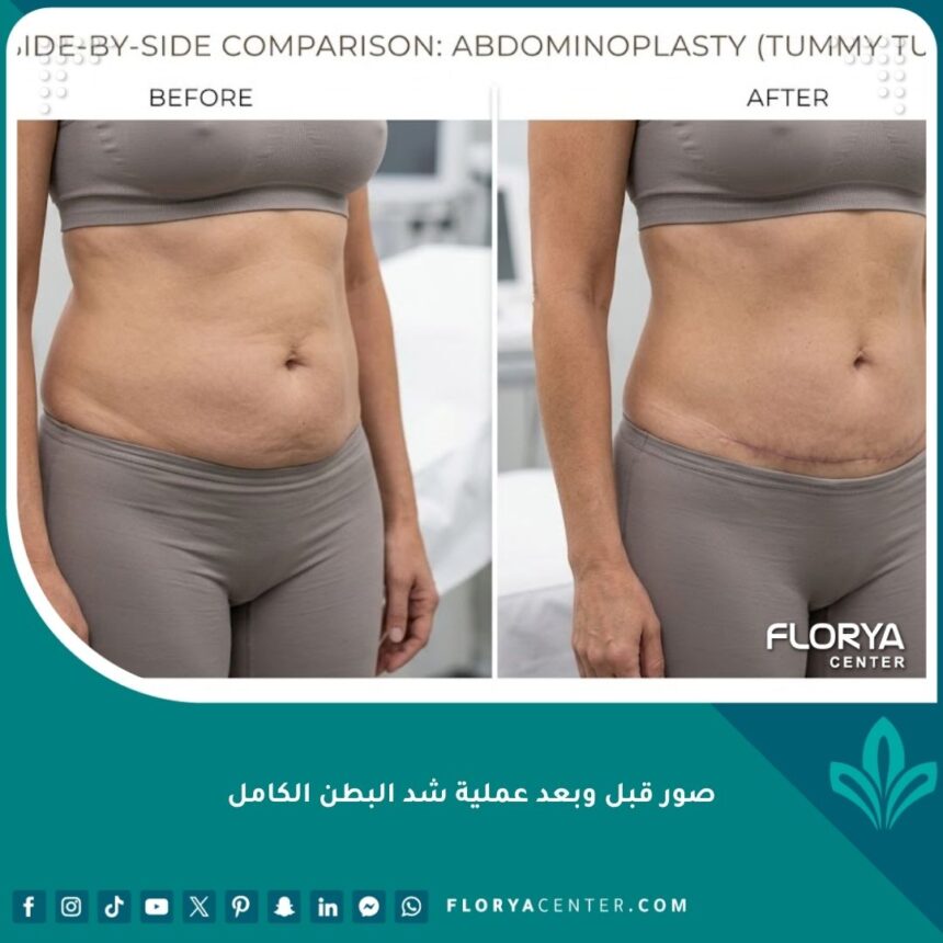 صور قبل وبعد عملية شد البطن الكامل توضح نتائج الجراحة التجميلية المذهلة للتخلص من الترهلات.