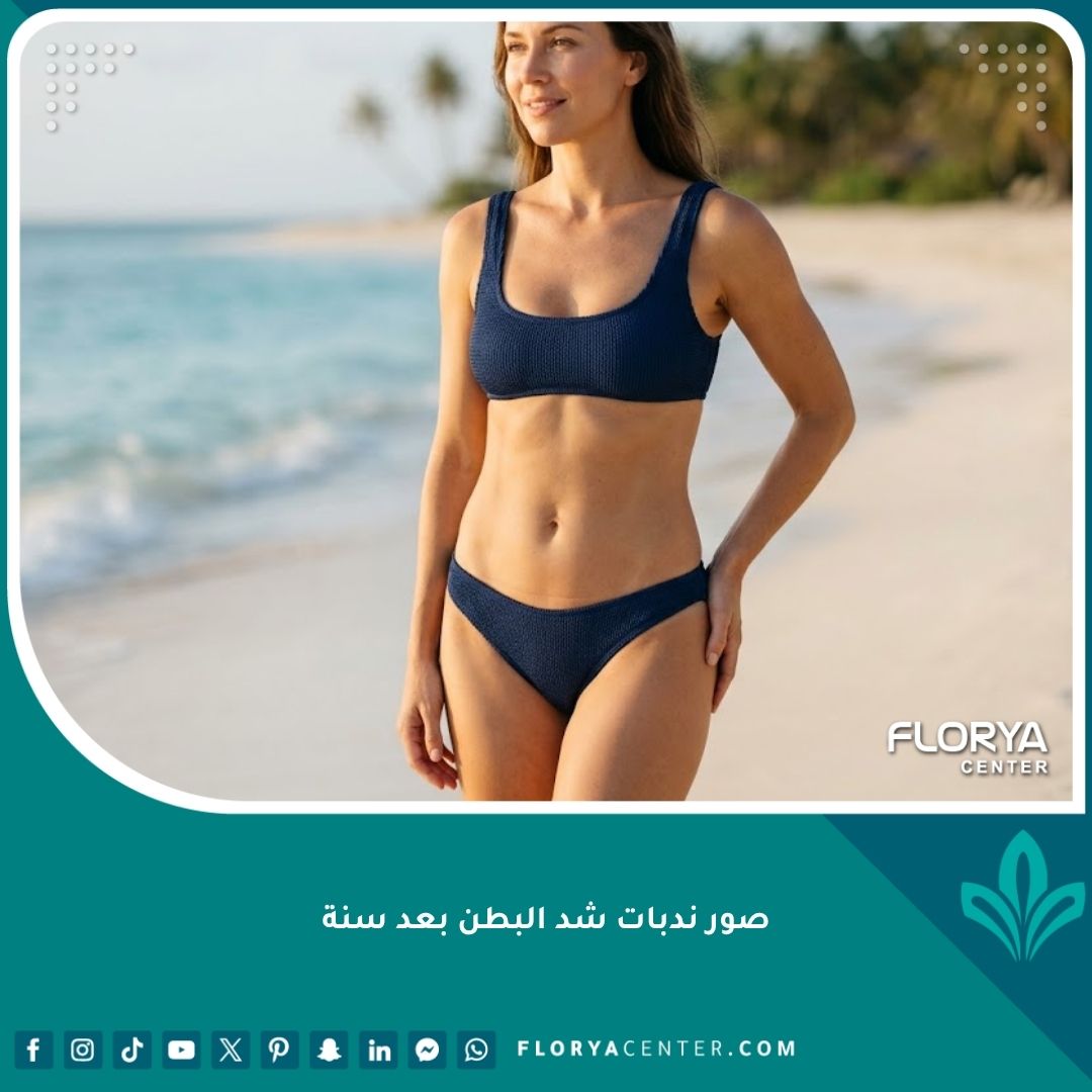 صورة واقعية لامرأة بملابس السباحة توضح سهولة إخفاء ندبة شد البطن بعد سنة تحت البكيني بالكامل بفضل موقعها المنخفض.