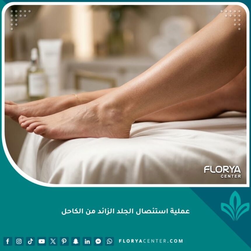 صورة مقربة تبرز جمال وتناسق الكاحل بعد الخضوع لعملية استئصال الجلد الزائد من الكاحل في عيادة تجميل راقية.